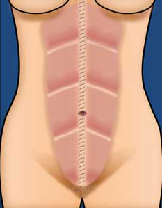 Abdominal Wall